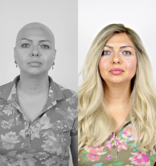 Kadınlarda Protez Saç Kullanımı