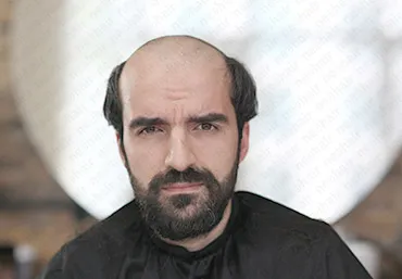 Protez Saç Öncesi Sonrası 1