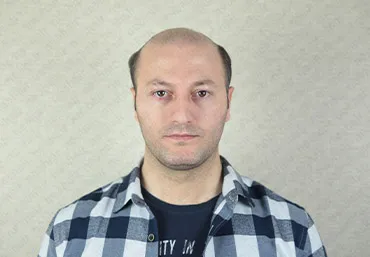 Protez Saç Öncesi Sonrası 3