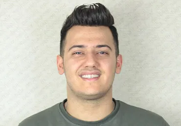 Protez Saç Öncesi Sonrası 6