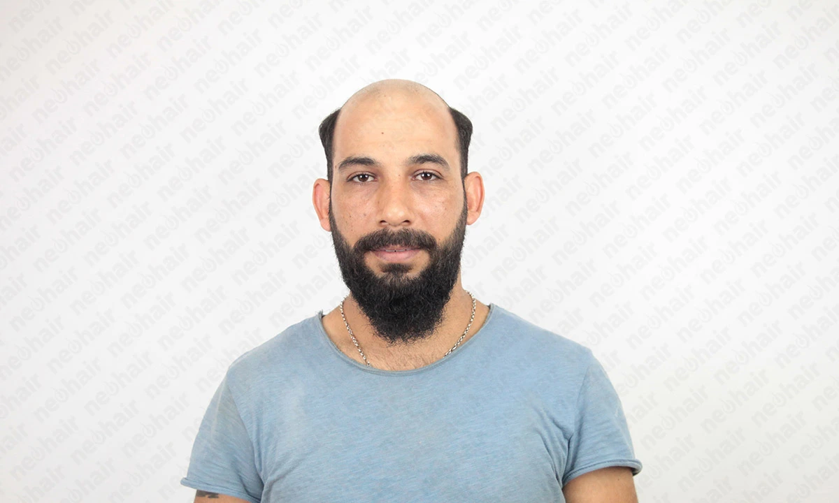 Erkekler İçin Doğal Görünümlü Protez Saç Seçenekleri Erkek protez saç modelleri, erkeklerde saç protezi uygulamaları ve sonuçları