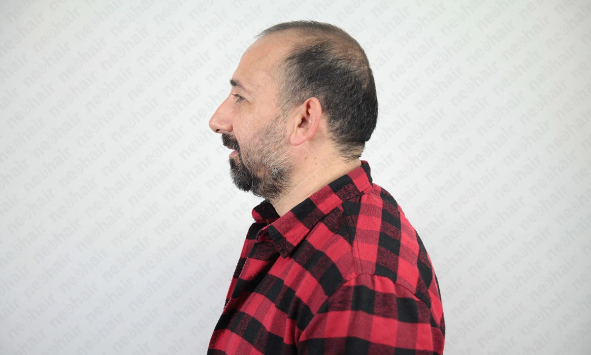 Protez Saç Kullanımına Uygun Kişi Profilleri Kimler protez saç kullanabilir? Saç protezi için uygun adaylar