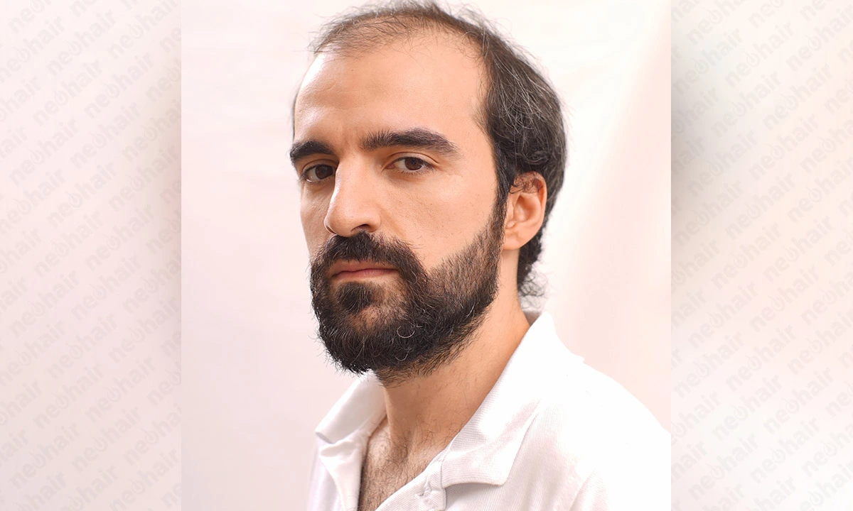 Protez Saç Seçiminde Dikkat Edilmesi Gerekenler Protez saç seçimi nasıl yapılır? En uygun protez saçınızı seçme rehberi